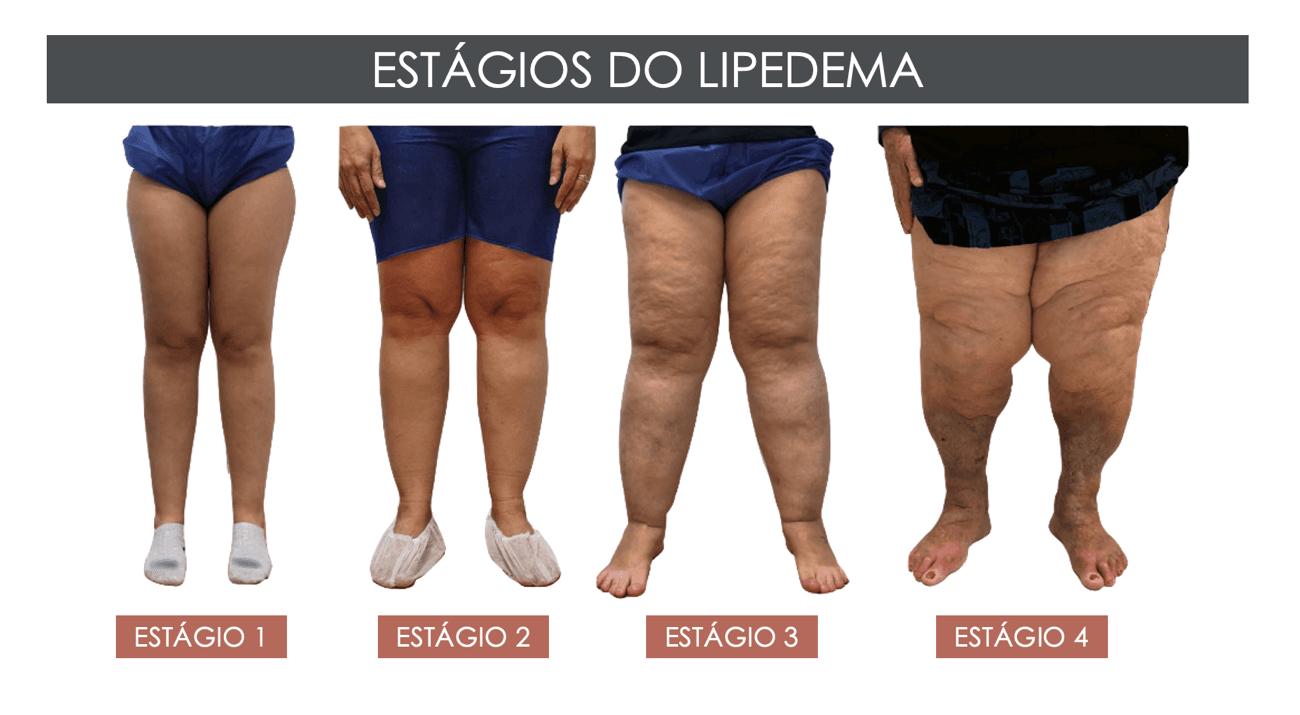 Estágios do Lipedema